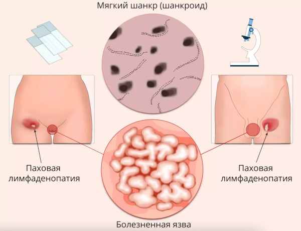 Мягкий шанкр. Фото, что это, лечение