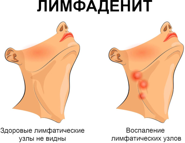 Мягкий шанкр. Фото, что это, лечение