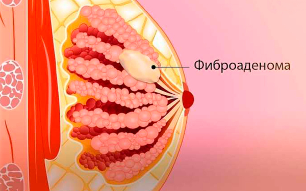 Что нельзя делать после удаления фиброаденомы молочной железы