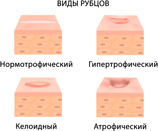 Что нельзя делать после удаления фиброаденомы молочной железы