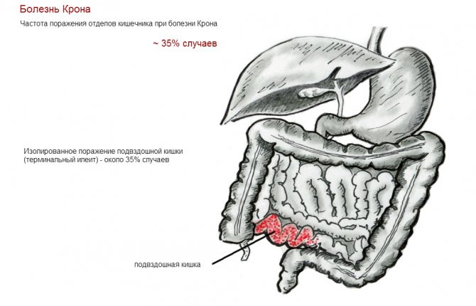 Терминальный илеит что это такое. Клинические рекомендации