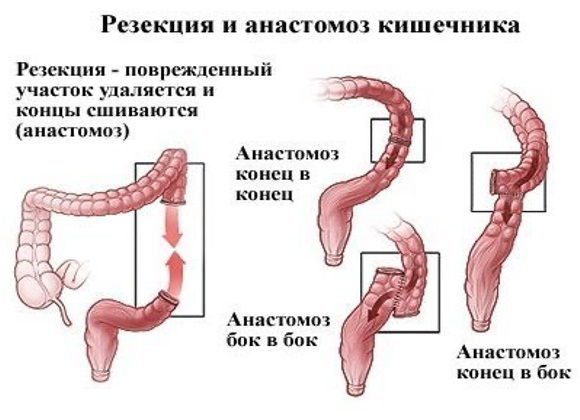 Терминальный илеит что это такое. Клинические рекомендации