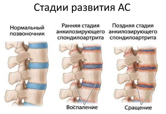 Терминальный илеит что это такое. Клинические рекомендации