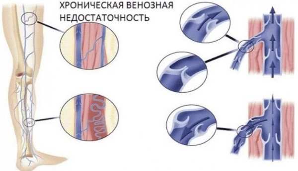 Тромбовазим (Trombovazim). Инструкция по применению, отзывы