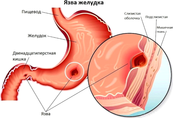 Тромбовазим (Trombovazim). Инструкция по применению, отзывы