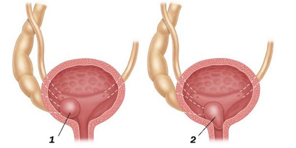 Уретероцеле мочевого пузыря у женщин. Что это, лечение