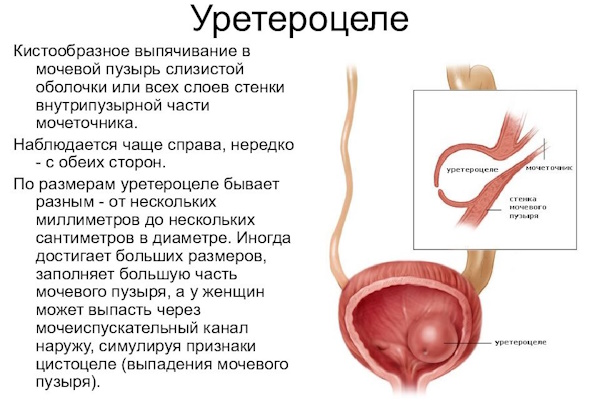 Уретероцеле мочевого пузыря у женщин. Что это, лечение