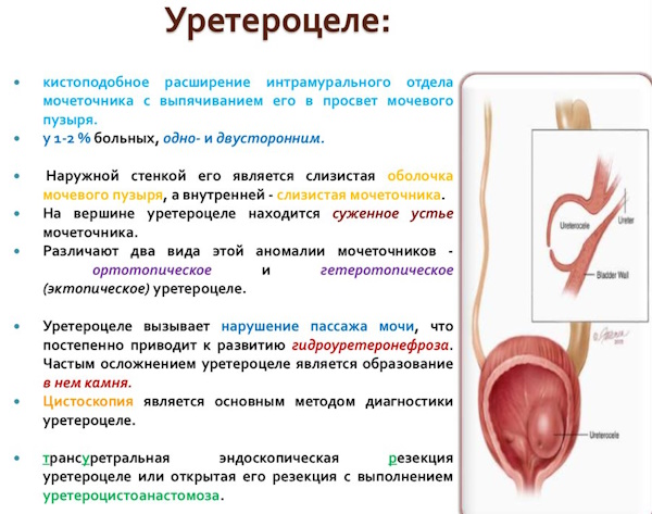 Уретероцеле мочевого пузыря у женщин. Что это, лечение