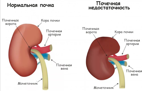 Уретероцеле мочевого пузыря у женщин. Что это, лечение