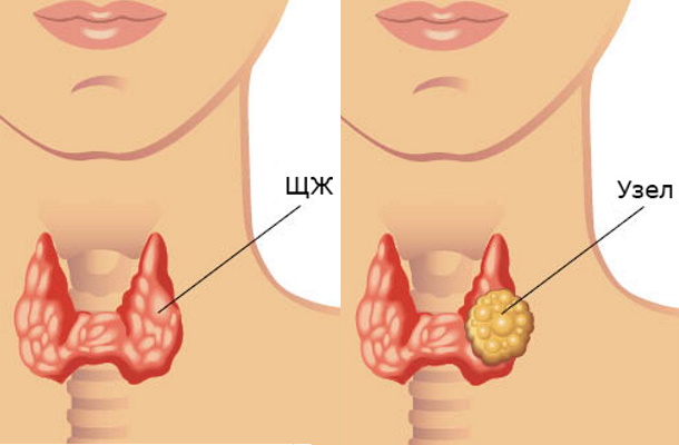 Узловой зоб щитовидной железы у взрослых. Клинические рекомендации