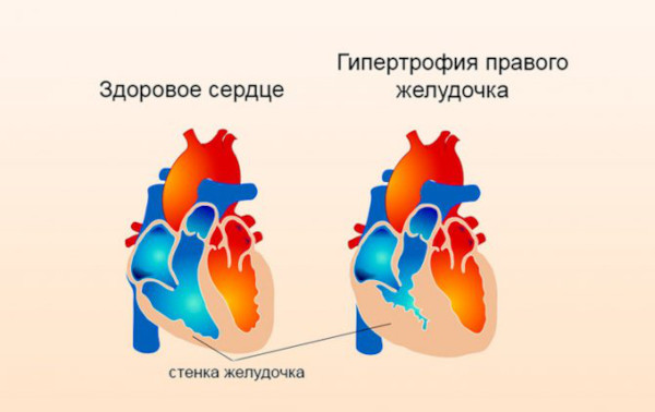 Воронкообразная грудная клетка у ребенка. Причины, фото