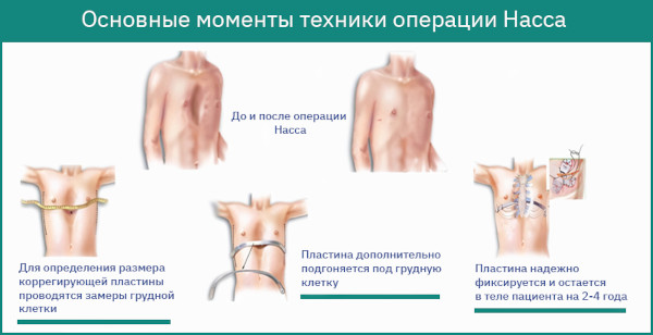 Воронкообразная грудная клетка у ребенка. Причины, фото