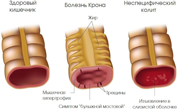 Воспалительные заболевания толстого кишечника. Симптомы, лечение