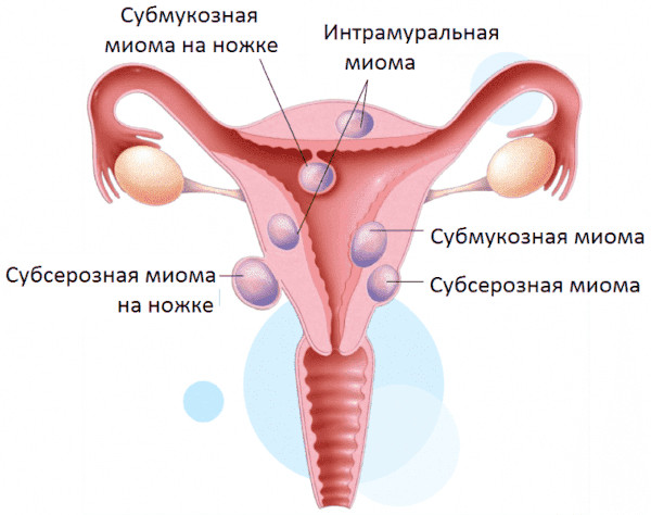 Заболевания матки у женщин. Виды, симптомы, названия