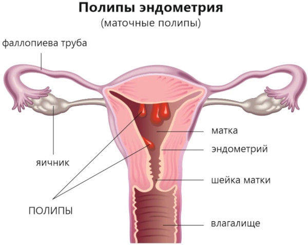 Заболевания матки у женщин. Виды, симптомы, названия