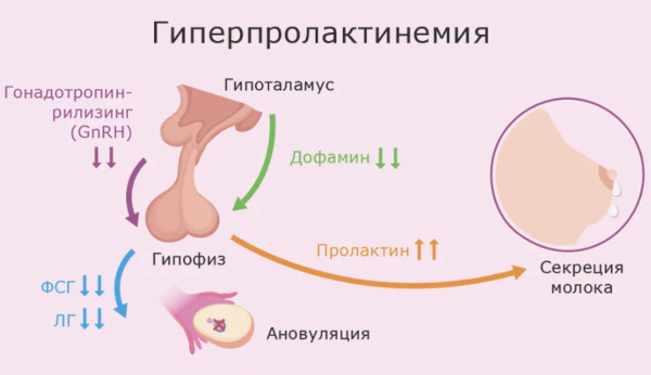 Гиперандрогения у женщин. Что это, симптомы, лечение