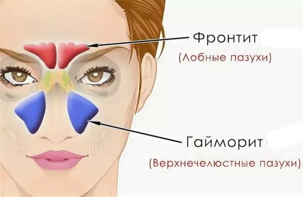 Фронтит и гайморит: разница, если одновременно, лечение