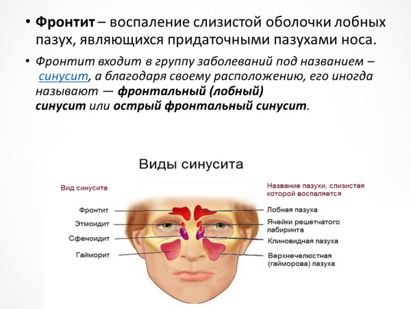 Фронтит и гайморит: разница, если одновременно, лечение