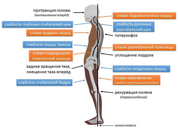 Гипертонус мышц спины у взрослых. Симптомы и лечение