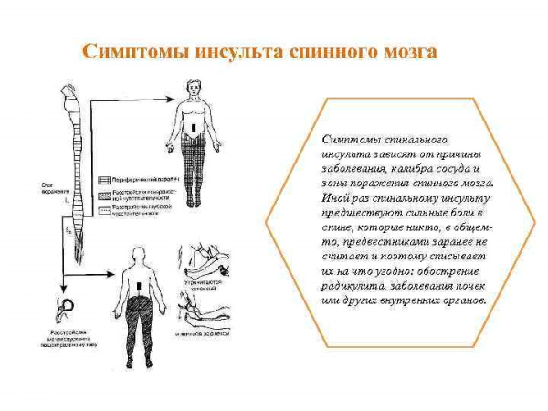 Инсульт спинного мозга (спинальный). Симптомы, лечение