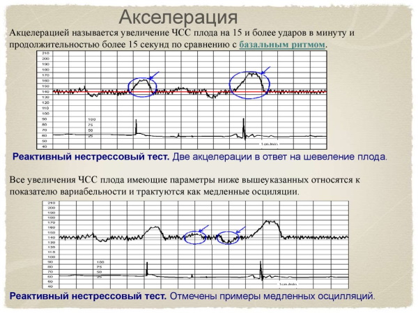 КТГ при беременности (кардиотокография плода). Сколько длится, как, когда делают