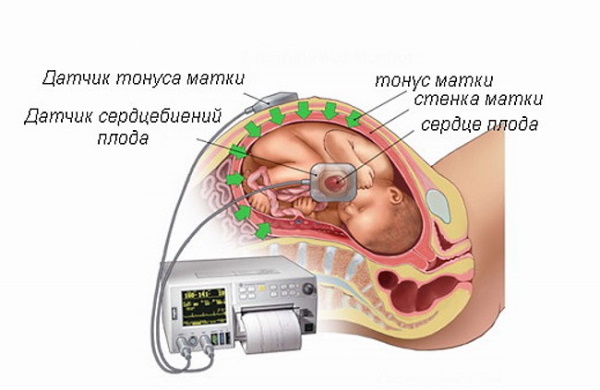 КТГ при беременности (кардиотокография плода). Сколько длится, как, когда делают
