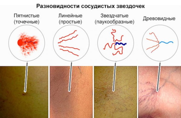 Лопаются сосуды (вены) на ногах. Почему, что делать