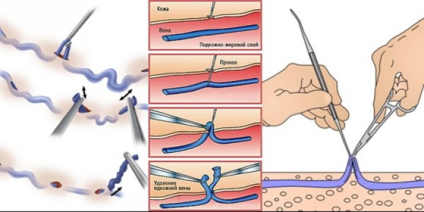 Флебит. Симптомы, лечение у женщин, фото