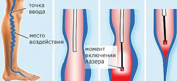 Лопаются сосуды (вены) на ногах. Почему, что делать