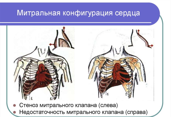 Митральная конфигурация сердца. Рентгенограмма, что это, характеристика