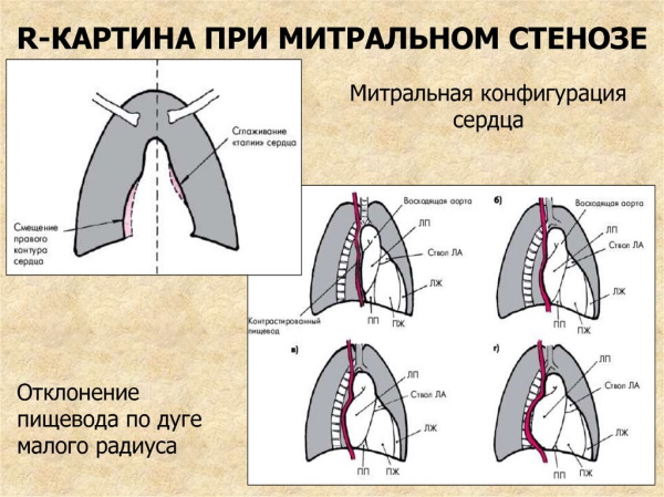 Митральная конфигурация сердца. Рентгенограмма, что это, характеристика