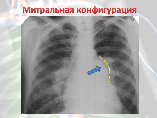 Митральная конфигурация сердца. Рентгенограмма, что это, характеристика