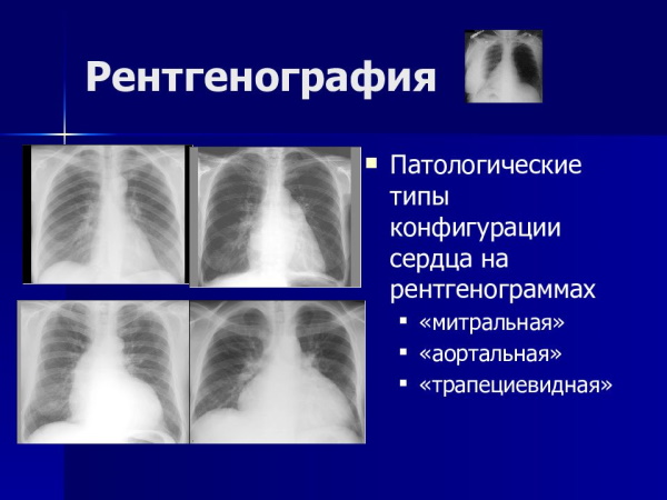 Митральная конфигурация сердца. Рентгенограмма, что это, характеристика