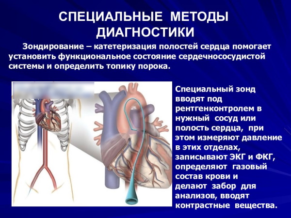 Митральная конфигурация сердца. Рентгенограмма, что это, характеристика