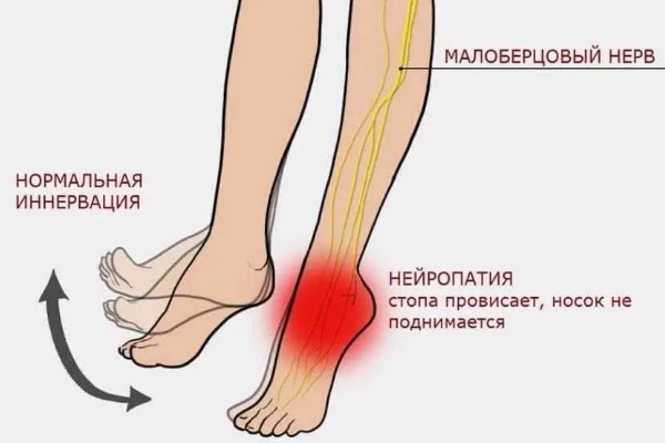 Невропатия (неврит) малоберцового нерва. Симптомы, лечение