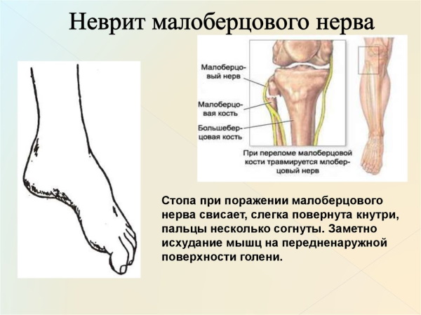 Невропатия (неврит) малоберцового нерва. Симптомы, лечение