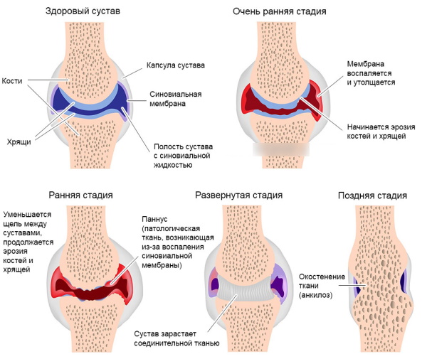 Остеопороз коленного сустава 1-2-3 степени. Симптомы, лечение