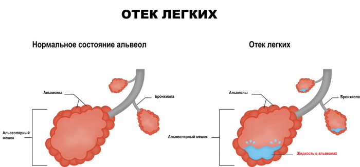 Отравление уксусом. Симптомы, первая помощь, рекомендации