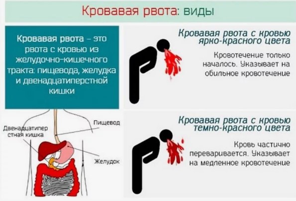 Отравление уксусом. Симптомы, первая помощь, рекомендации