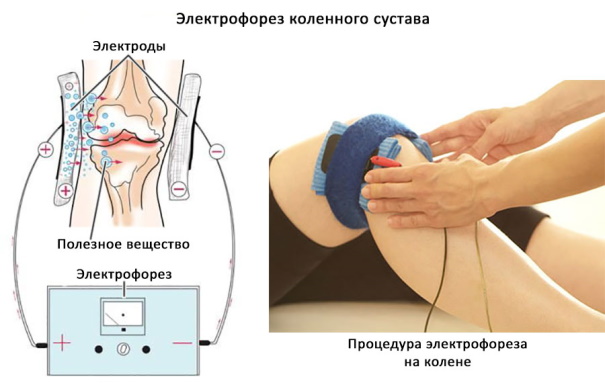 Рекурвация коленного сустава. Лечение