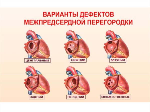 Пороки сердца врожденные и приобретенные. Виды, классификация