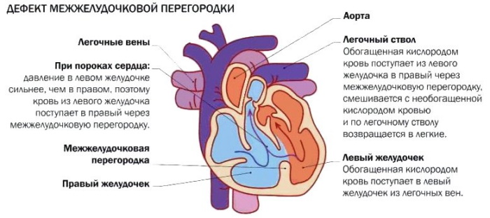 Пороки сердца врожденные и приобретенные. Виды, классификация