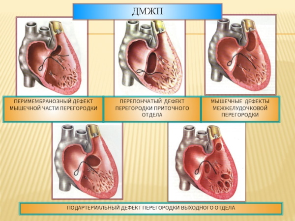 Пороки сердца врожденные и приобретенные. Виды, классификация
