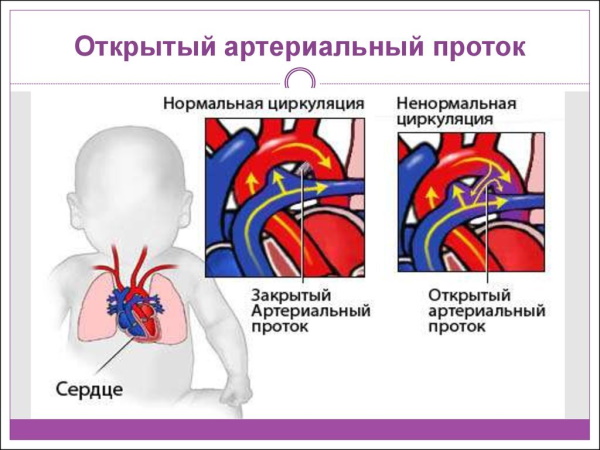 Пороки сердца врожденные и приобретенные. Виды, классификация