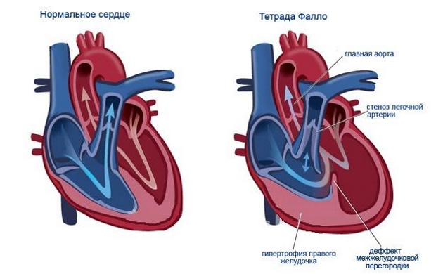 Пороки сердца врожденные и приобретенные. Виды, классификация