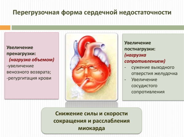 Признаки сердечной недостаточности. Симптомы у женщин, мужчин