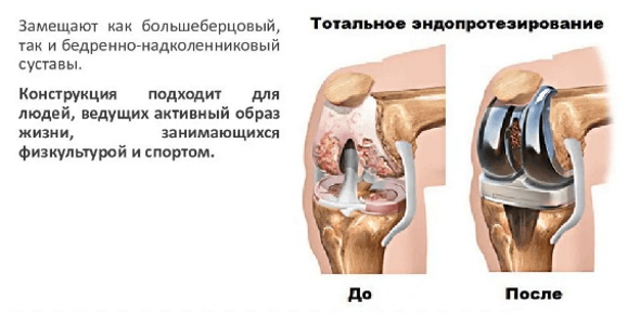 Рекурвация коленного сустава. Лечение