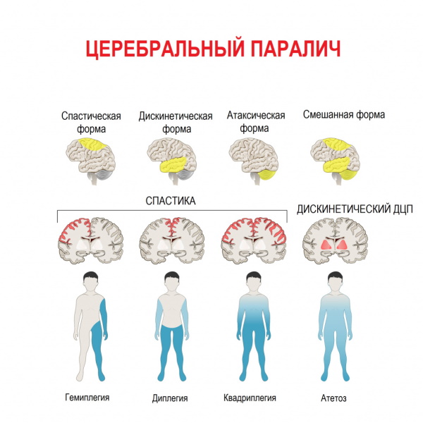 Рекурвация коленного сустава. Лечение