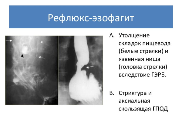 Рентгеноскопия пищевода, желудка с барием. Как делается, цена