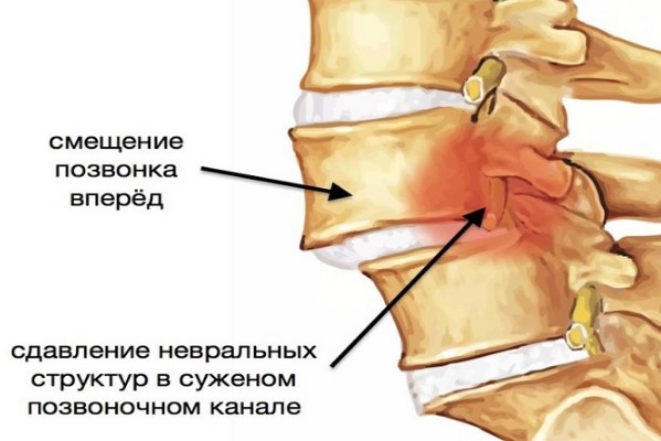 Смещение позвонков грудного отдела. Симптомы, лечение, упражнения